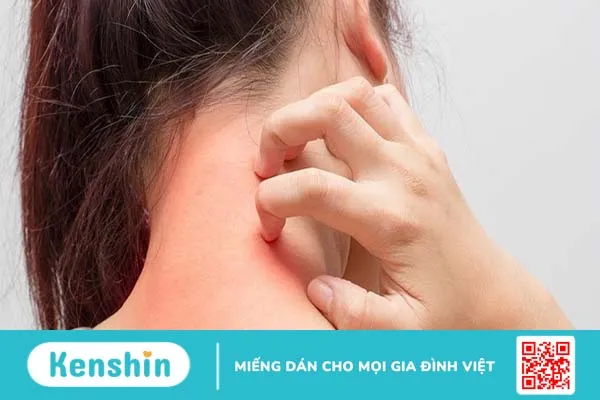 Dấu hiệu nhận biết bạn bị bệnh mề đay ánh sáng mặt trời