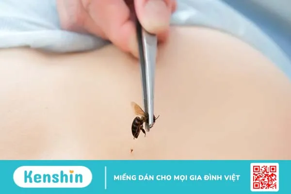 Dị ứng côn trùng đốt phải làm sao?