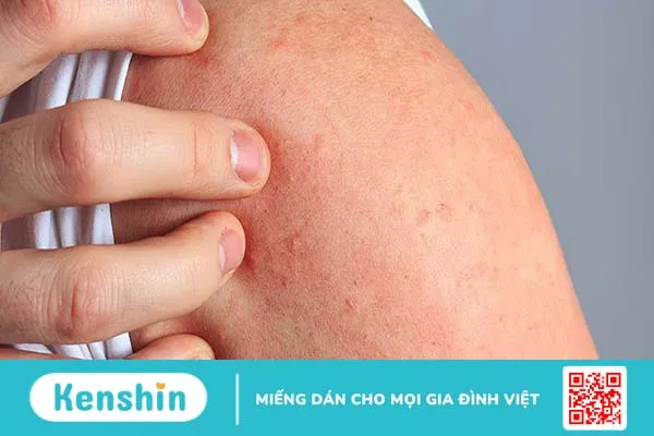 Dị ứng dưa hấu là gì? Cần phải làm gì khi bị dị ứng dưa hấu?