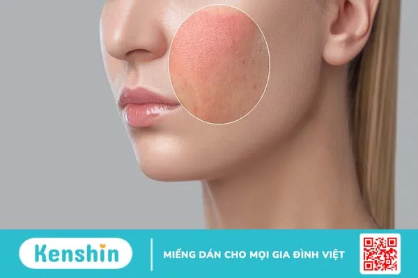 Dị ứng mỹ phẩm nên bôi thuốc gì?