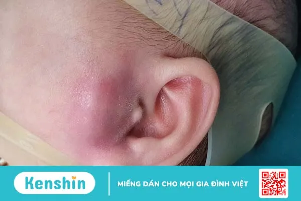 Điều trị nhọt ống tai ngoài an toàn và hiệu quả theo từng giai đoạn