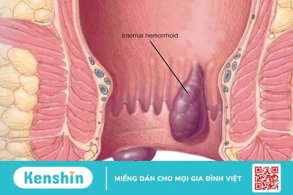 Đơn vị nào chữa bệnh trĩ ở Vũng Tàu uy tín nhất hiện nay