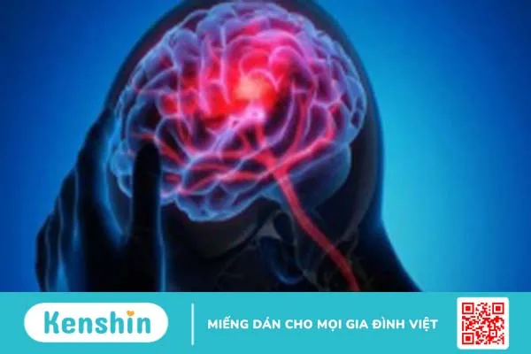 Đột quỵ và rung nhĩ là gì? Mối quan hệ giữa đột quỵ và rung nhĩ