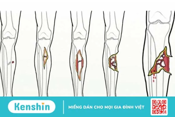 Gãy xương hở: Nguyên nhân, biến chứng và cách điều trị