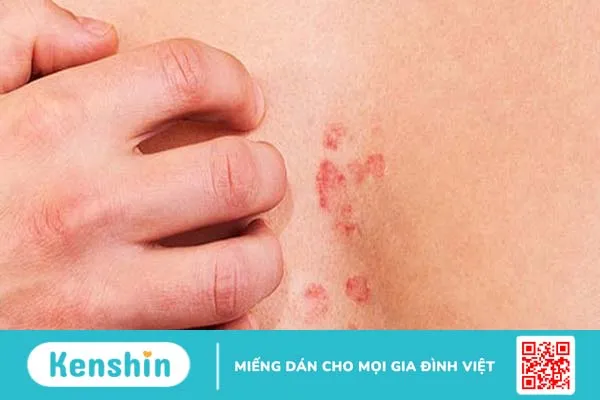 Giải đáp: Bị dị ứng nên tắm nước nóng hay lạnh?