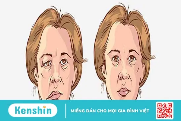 Giải đáp: Liệt dây thần kinh số 7 có tự khỏi không?