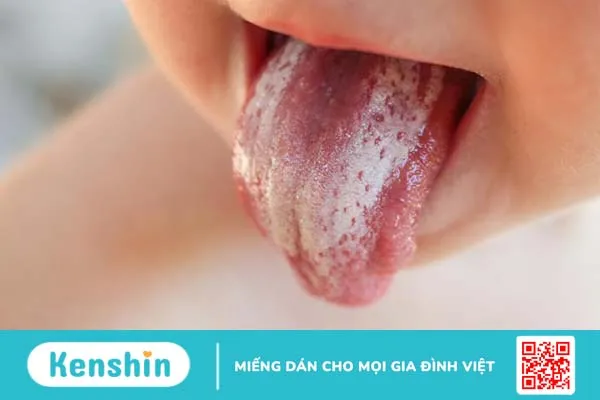 Giải đáp: Nấm miệng bôi thuốc gì để nhanh khỏi?