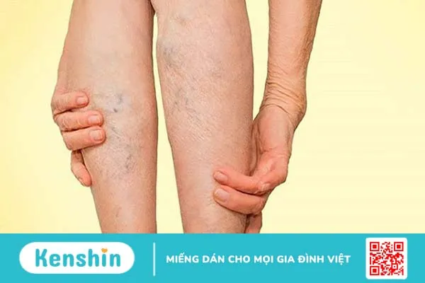 Giải đáp thắc mắc: Giãn tĩnh mạch nông chi dưới là gì?