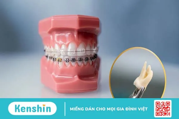 Giải đáp thắc mắc: Niềng răng có phải nhổ răng không?