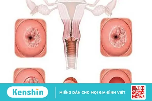 Giải đáp thắc mắc: Viêm lộ tuyến tử cung có lây không?