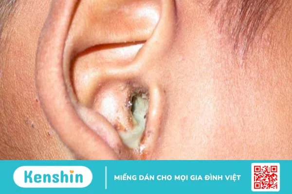 Góc hỏi đáp: Bệnh nấm ống tai có nguy hiểm không?