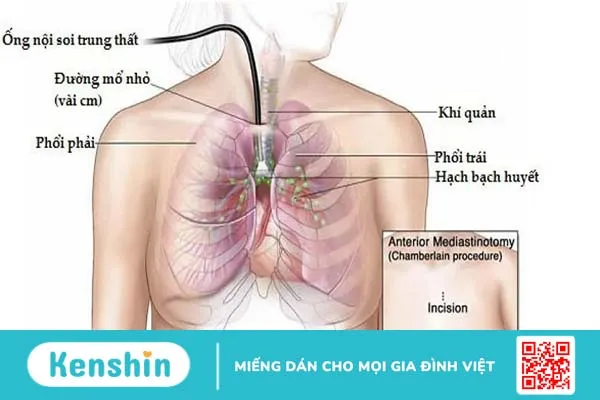 Hạch trung thất là gì? Các bệnh lý liên quan đến hạch trung thất