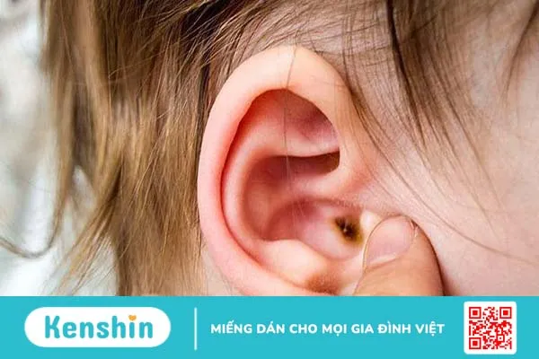 Hiểu về nấm ống tai ở trẻ em để phòng ngừa bệnh hiệu quả