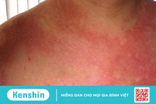 Hình ảnh lupus ban đỏ dạng đĩa thường xuất hiện như thế nào?