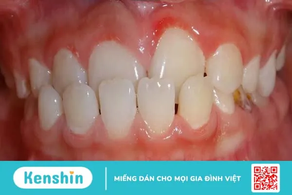 Hô hàm dưới: Nguyên nhân, tác hại và phương hướng khắc phục