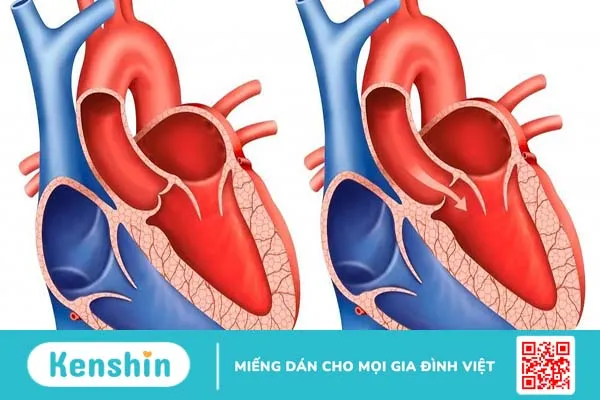 Hở van động mạch chủ 1/4 có nguy hiểm không?