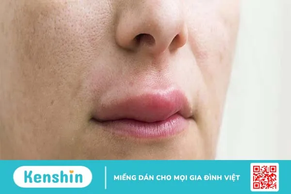 Hội chứng dị ứng miệng và những điều cần biết