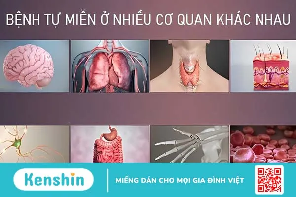 Hội chứng nhược cơ Lambert-Eaton: Dấu hiệu, nguyên nhân và cách điều trị