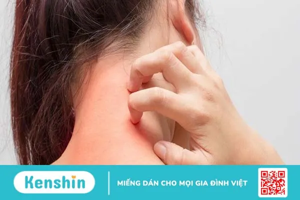 Hội chứng tăng IgE là gì và có nguy hiểm không?