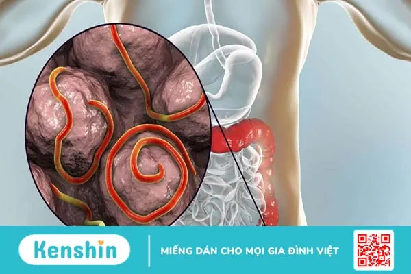 Hướng dẫn cách bắt giun kim ở bộ phận sinh dục nữ