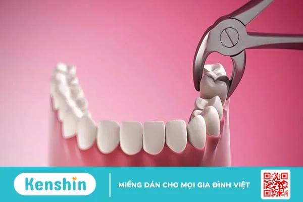 Hướng dẫn chăm sóc sau khi nhổ răng khôn