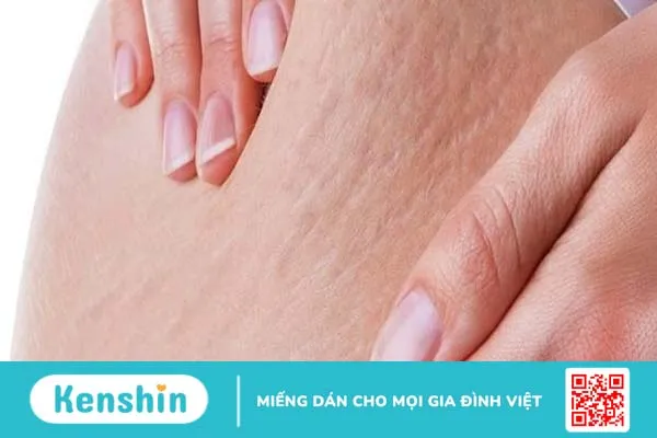 Hướng dẫn trị rạn da mông bằng dầu dừa đúng cách