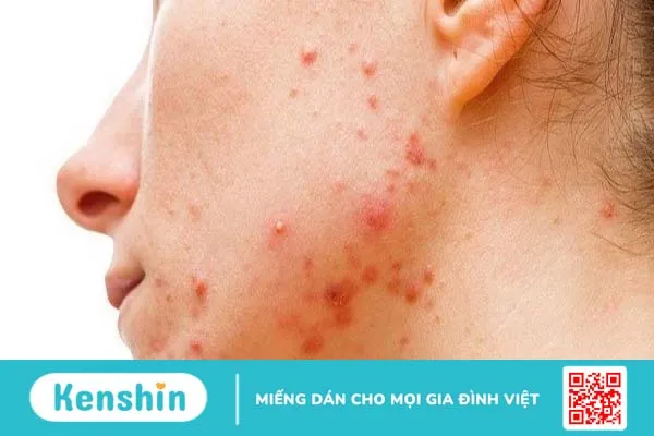 Khi dùng BHA bị đẩy mụn thì có nên nặn không?