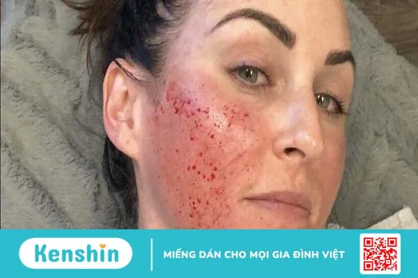 Lăn kim bị sưng mặt phải làm sao?