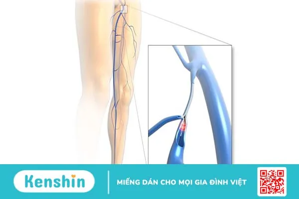 Laser nội tĩnh mạch: Phương pháp trong điều trị suy giãn tĩnh mạch chân