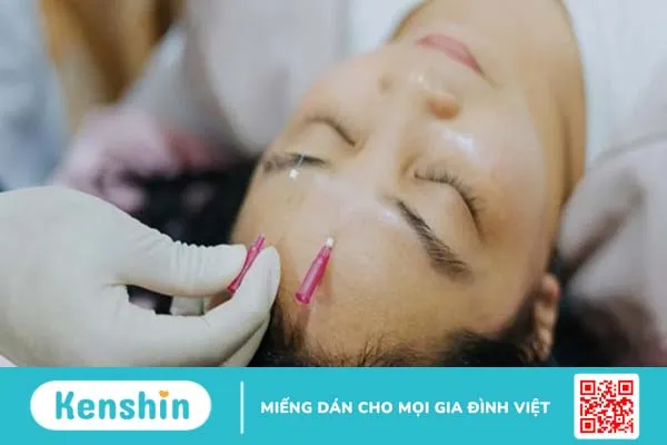 Liệt dây thần kinh số 7 châm cứu bao lâu thì hết bệnh?