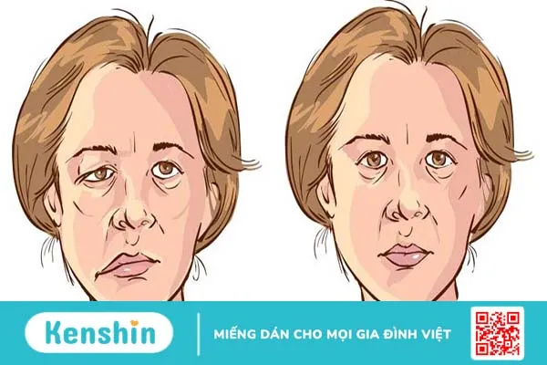 Liệt mặt do lạnh: Dấu hiệu nhận biết và cách khắc phục