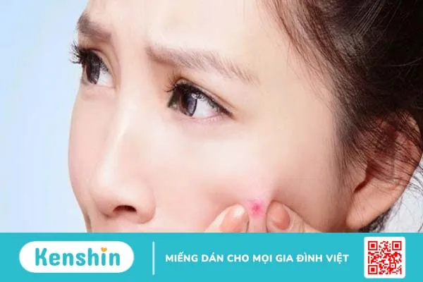 Loại mụn nào có thể nặn? Cách nặn mụn không để lại thâm sẹo