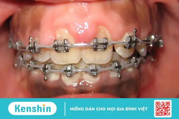 Lợi trùm khi niềng răng: Nguyên nhân, triệu chứng và cách khắc phục