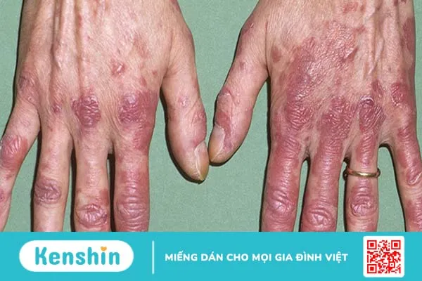 Lupus ban đỏ có mấy loại? Biến chứng của lupus ban đỏ nguy hiểm như thế nào?