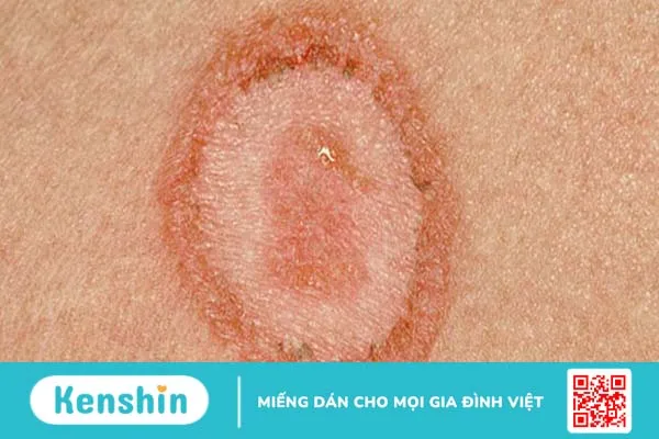 Lupus ban đỏ dạng đĩa có ngứa không?