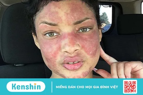 Lupus ban đỏ miễn dịch có nguy hiểm không? Làm sao để giảm căng thẳng khi mắc bệnh