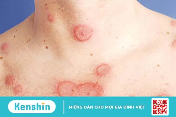 Lupus ban đỏ ở cổ có nguy hiểm không?