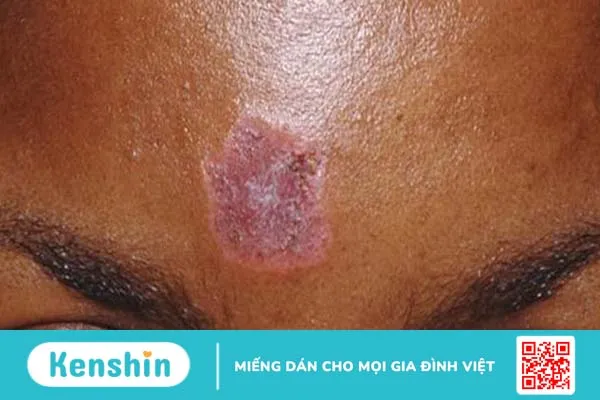 Lupus ban đỏ ở mặt có các dạng tổn thương nào?