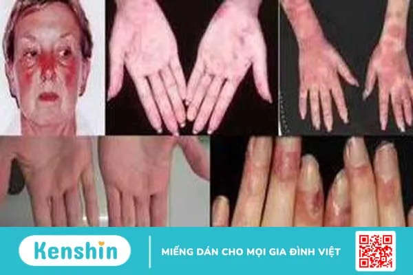 Lupus ban đỏ và vảy nến: Tổng quan và các triệu chứng