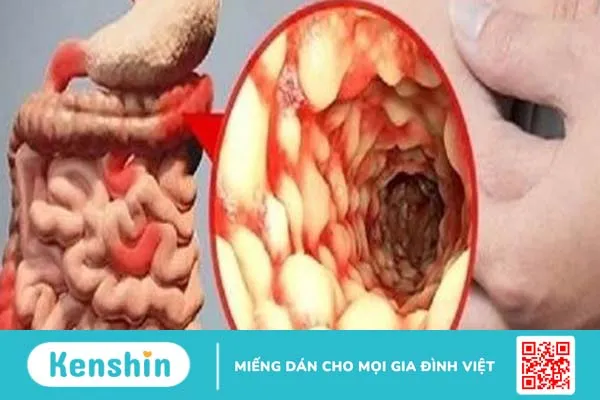 Mắc bệnh Crohn nên ăn gì để cải thiện tình trạng bệnh?