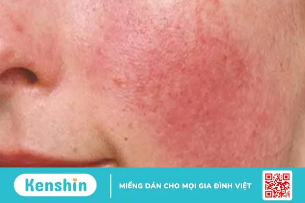 Mách bạn cách trị mụn do dị ứng mỹ phẩm