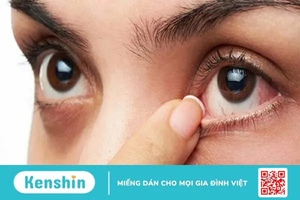 Mắt bị ghèn sợi: Nguyên nhân và xử trí