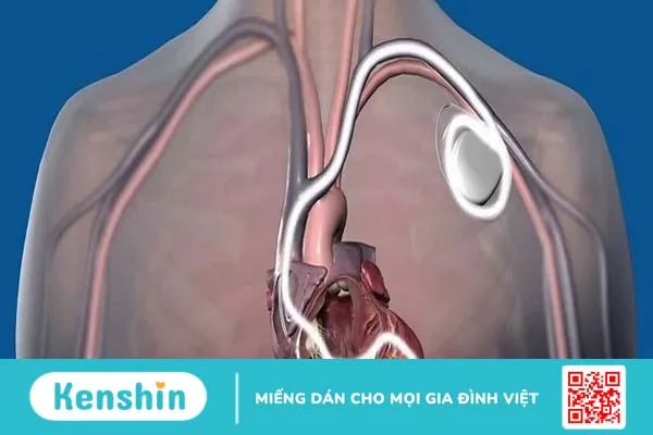 Máy khử rung tim và những điều cần lưu ý