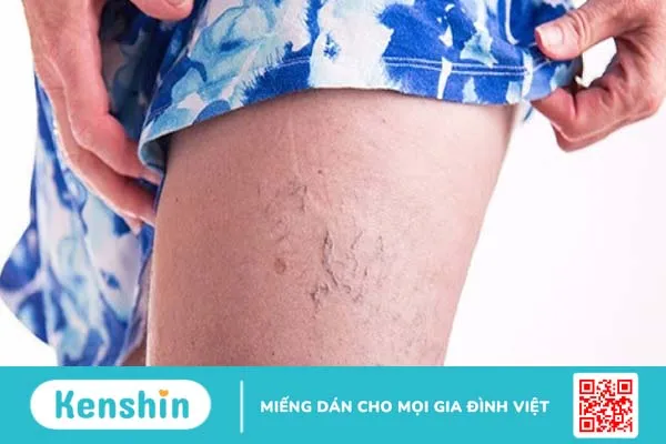 Mẹo chữa suy giãn tĩnh mạch chân khi mang thai an toàn cho mẹ bầu