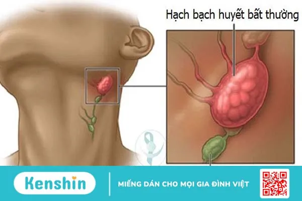 Mổ hạch ở cổ có nguy hiểm không? Lưu ý và các biến chứng sau mổ hạch