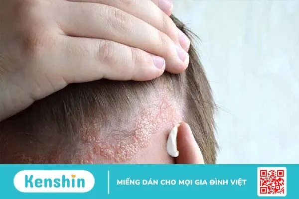 Một số bệnh nấm da thường gặp và cách điều trị