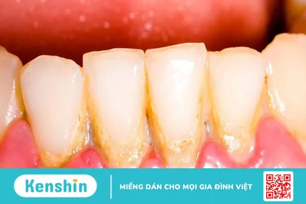 Một số nguyên nhân gây mảng bám trên răng và cách phòng ngừa hiệu quả