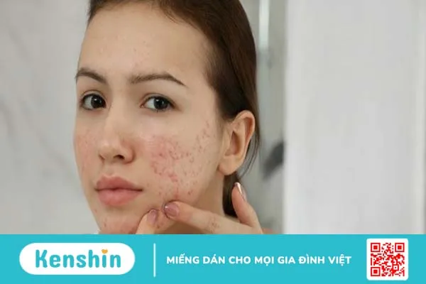 Mụn đỏ ở má: Nguyên nhân và cách điều trị