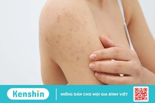 Mụn nhọt ở tay có nguy hiểm không và cách điều trị thế nào?