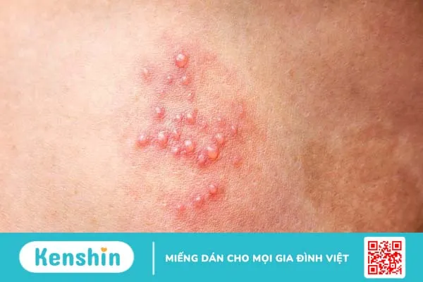 Mụn rộp sinh dục nam: Nguyên nhân và cách phòng ngừa